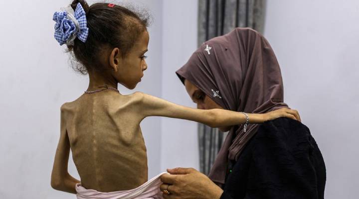 В Газе растет число смертей от голода на фоне эскалации еврейских бомбежек